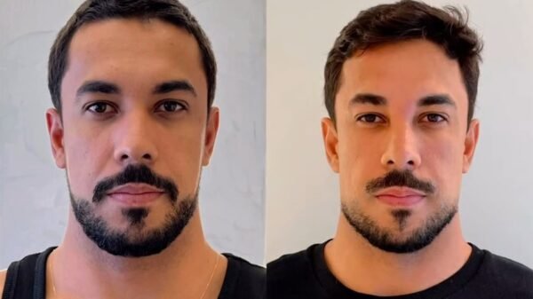 Ex-BBB Maike comenta repercussão de harmonização facial: "Tava ruim, já"