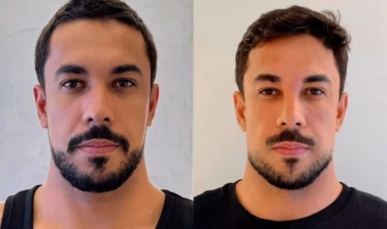 Ex-BBB Maike comenta repercussão de harmonização facial: "Tava ruim, já"