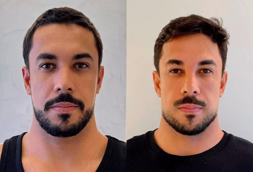 Ex-BBB Maike comenta repercussão de harmonização facial: "Tava ruim, já"