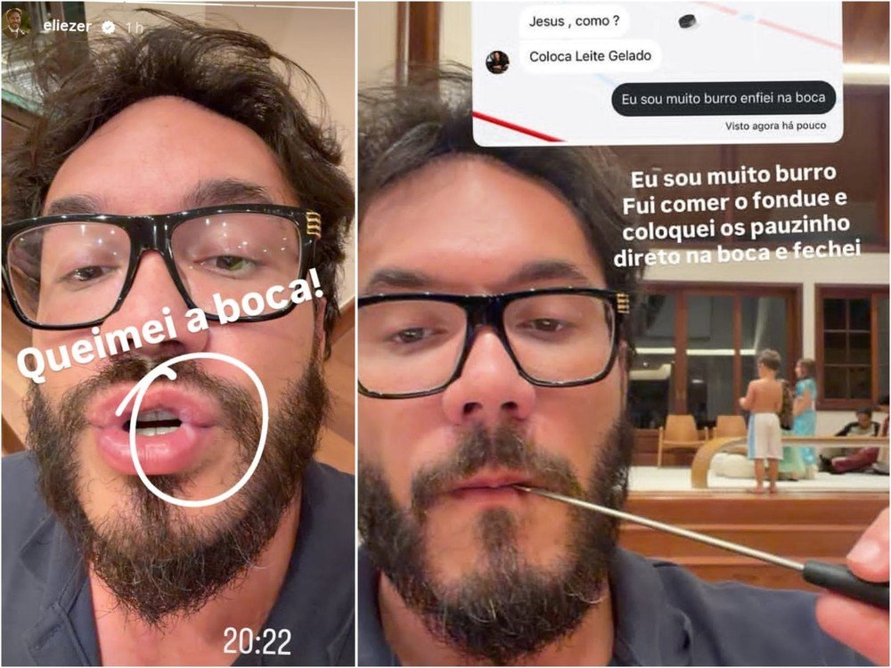 Eliezer sofre queimadura nos lábios após acidente doméstico
