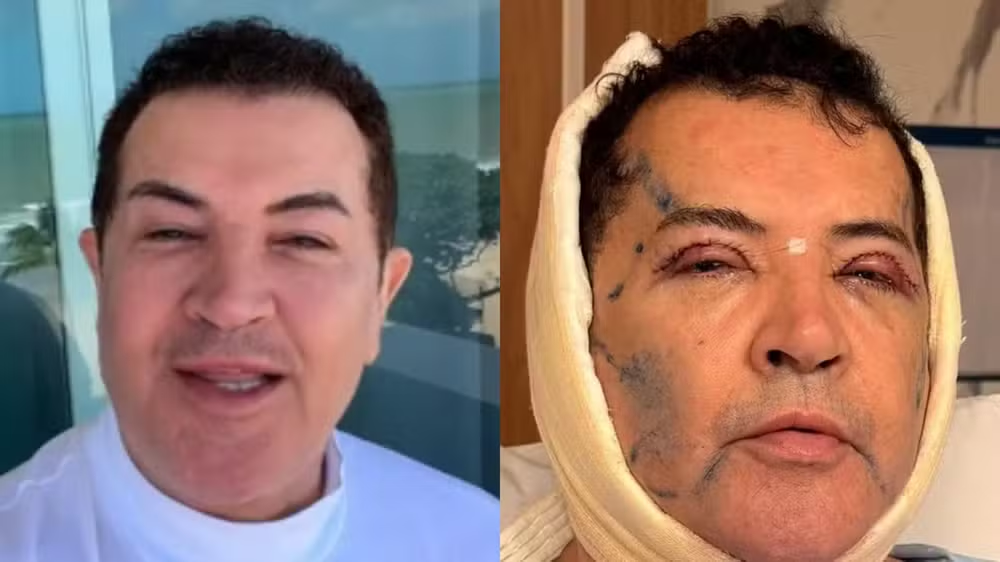Beto Barbosa passa por cirurgia plástica e choca ao mostrar rosto inchado após procedimento: "Novo visual" 47 Beto Barbosa passa por cirurgia plástica e choca ao mostrar rosto inchado após procedimento: "Novo visual"