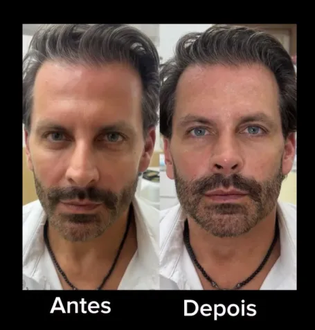 Henri Castelli faz nova harmonização facial e chama atenção pelo resultado; veja o antes e depois